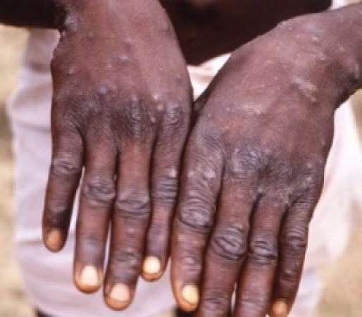 Mpox: भारत में खतरनाक वायरस एमपॉक्स के पहले केस की पुष्टि हो गई है। इस वायरस से संक्रमित पुरुष ने हाल ही में एमपॉक्स से संक्रमित