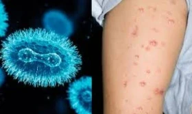 Monkeypox: देश में मंकीपॉक्स का दूसरा मामला सामने आया है। केरल सरकार ने बुधवार को इसकी पुष्टि करते हुए कहा कि संयुक्त अरब