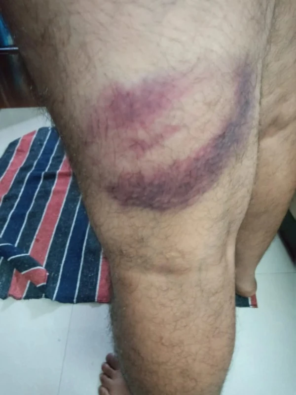 अतिथि शिक्षकों पर लाठी चार्ज