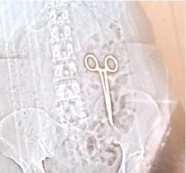 22 महीने से पेट में कैंची लेकर घूम रही महिला