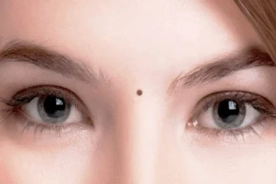 Mole Between Eyebrows