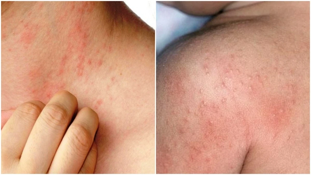 Prickly Heat Home Remedy