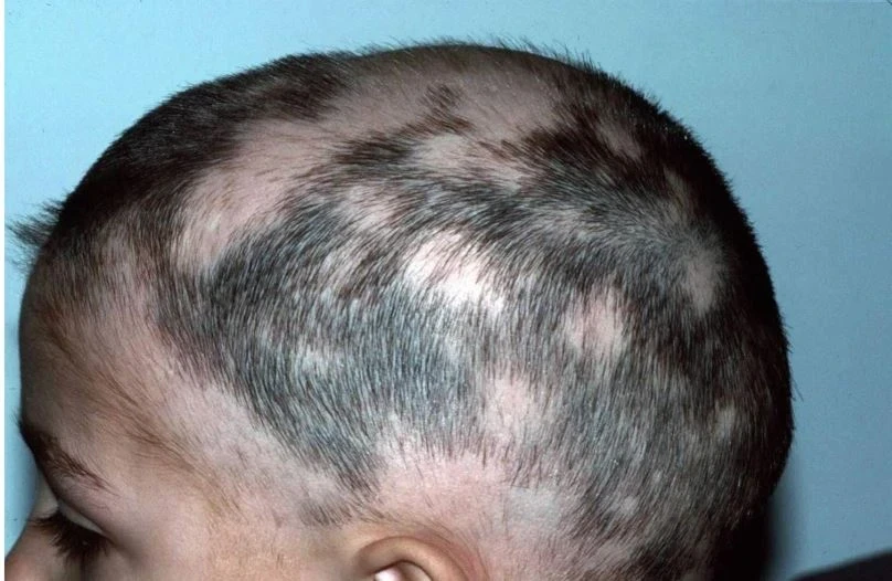 bald virus: शेगांव/नागपुर। महाराष्ट्र के बुलढाणा जिले के शेगांव तहसील में एक रहस्यमयी बीमारी ने लोगों में दहशत फैला दी है। कई गांवों में लोगों के नाखून अचानक गिरने लगे हैं। कुछ महीने पहले यहां के लोगों को 'गंजा वायरस' की वजह से